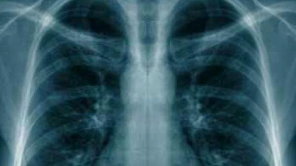 A fost identificat alimentul ce reduce cu 50% riscul de cancer la plămâni