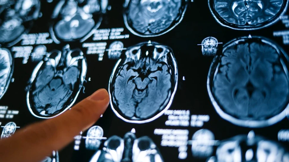 Oamenii de știință dezvăluie unde ar putea să își aibă originea schizofrenia în creier