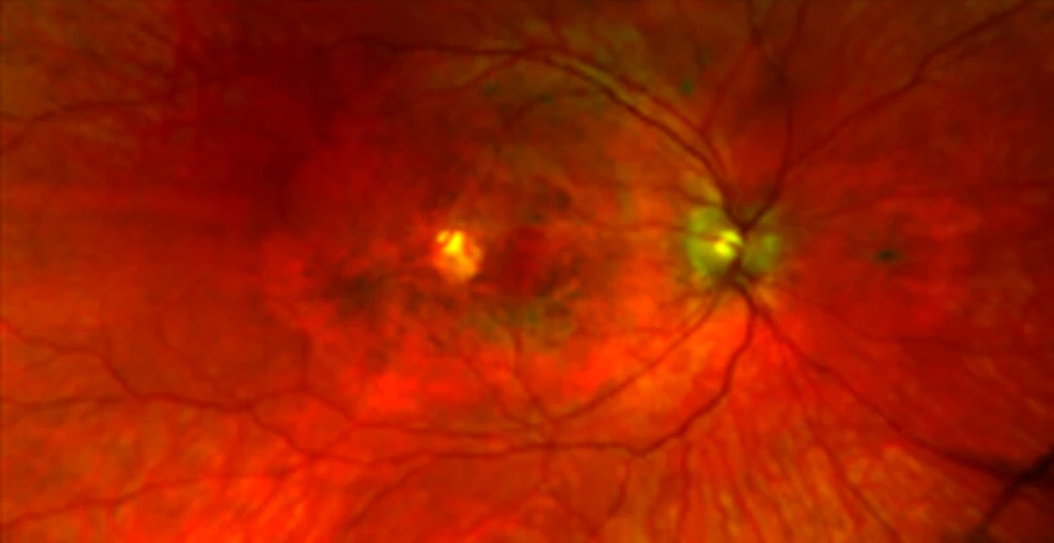 O nouă boală oculară genetică a fost descoperită. Cum se manifestă?