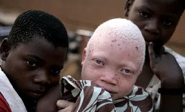 Albinosii sunt persecutati in Tanzania