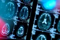 Un studiu major a identificat neuronii cei mai vulnerabili la boala Alzheimer