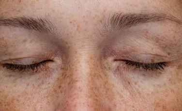 Paradoxul pistruilor: De la „semne ale diavolului” la cel mai dorit trend de beauty. Ce spune știința despre petele care fascinează lumea?
