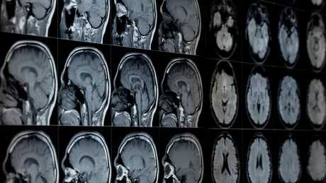 Speranța de viață ar putea fi aflată pe baza vârstei biologice a creierului